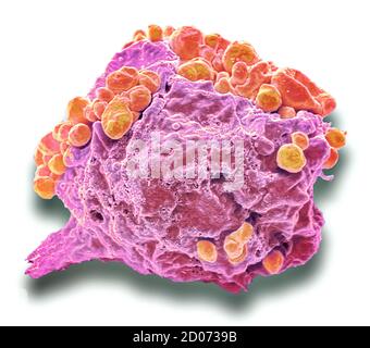 Linfoma di cellule di cancro. Color scanning electron microfotografia (SEM) di una cellula di linfoma che mostra in apoptosi precoce modifiche. Un linfoma è una cella di immu Foto Stock