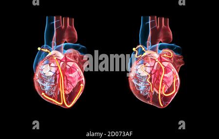 Cuore umano e sistema elettrico, illustrazione 3d. Le linee gialle mostrano il sistema elettrico (conduzione) del cuore. Il cuore di RIG Foto Stock