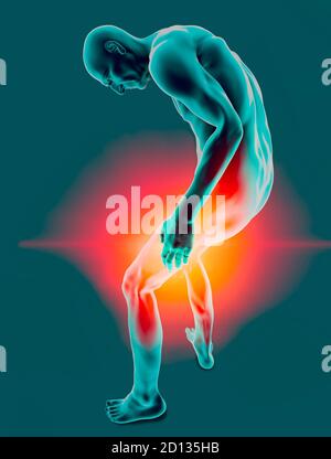 Frattura del femore, persona anziana. Ossa fragili e dolori muscolari. Osteoporosi. Rottura muscolare della gamba. Esercizio. Corpo umano e anatomia. rendering 3d Foto Stock