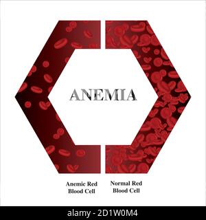 Anemia quantità di sangue rosso carenza di ferro anemia differenza di anemia quantità di globuli rossi e sintomi normali vettore illustrazione medica. Illustrazione Vettoriale
