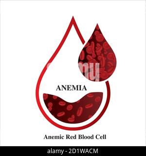 Anemia quantità di sangue rosso carenza di ferro anemia differenza di anemia quantità di globuli rossi e sintomi normali vettore illustrazione medica. Illustrazione Vettoriale