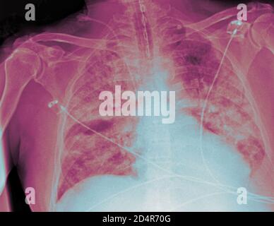 Polmoni affetti da coronavirus Covid-19, radiografia. Foto Stock