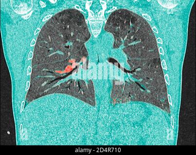 Polmoni affetti da coronavirus Covid-19, tomografia (TC). Foto Stock