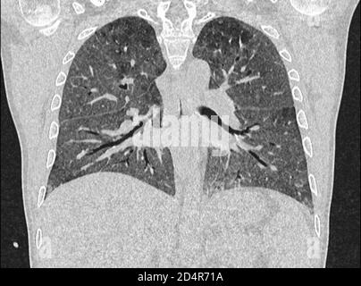 Polmoni affetti da coronavirus Covid-19, tomografia (TC). Foto Stock