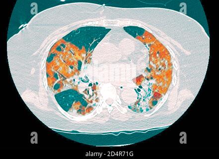 Polmoni affetti da coronavirus Covid-19, tomografia (TC). Foto Stock