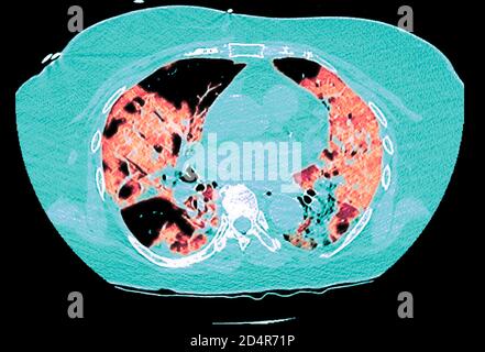 Polmoni affetti da coronavirus Covid-19, tomografia (TC). Foto Stock