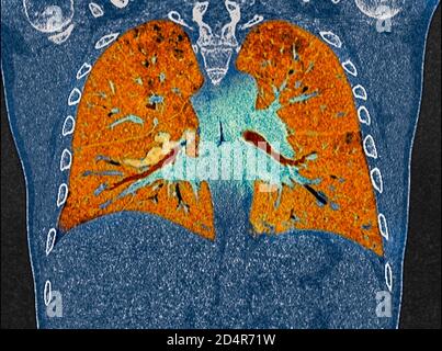 Polmoni affetti da coronavirus Covid-19, tomografia (TC). Foto Stock