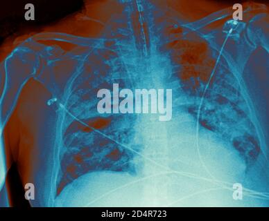 Polmoni affetti da coronavirus Covid-19, radiografia. Foto Stock