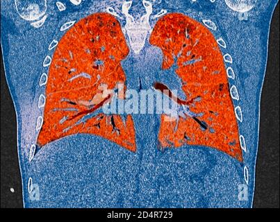 Polmoni affetti da coronavirus Covid-19, tomografia (TC). Foto Stock