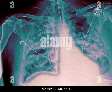 Polmoni affetti da coronavirus Covid-19, radiografia. Foto Stock