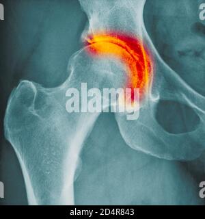 Radiografia che mostra l'artrite dell'anca, l'artrite è una malattia articolare che può causare distruzione della cartilagine, erosioni ossee, e infiammazione dei tendini. Foto Stock