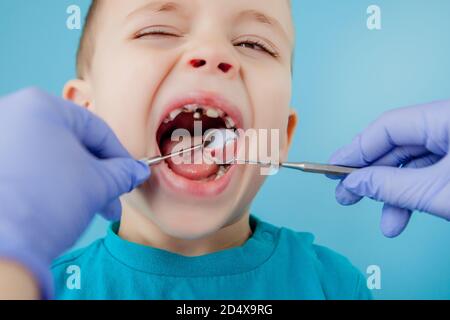 Primo piano delle mani del dentista con l'assistente in guanti blu stanno trattando i denti ad un bambino, il viso del paziente è chiuso Foto Stock