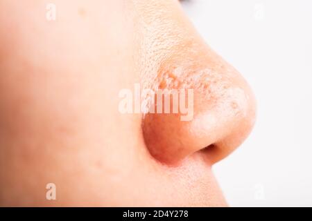 Closeup Asian giovane donna grandi pori hanno fleckles guancia oleosa, acne pimple sul naso, studio girato isolato su sfondo bianco, Healthcare bellezza pelle Foto Stock