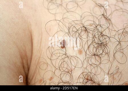 Macchia marrone sulla pelle. Macchie pigmentate e moli. Mole e capelli della pelle. Foto Stock