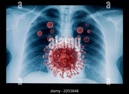 Malattia del coronavirus infezione del virus COVID-19 nei polmoni umani, nuova infezione del virus della corona o COVID (nuova malattia di Coronavirus 2019, COVID-19, nCoV, SAR Foto Stock