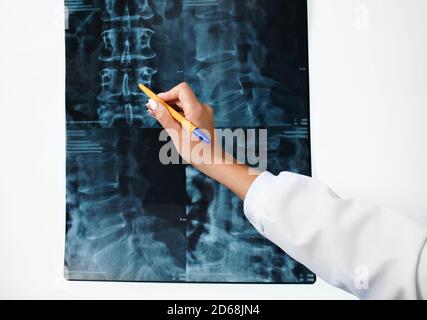 Negatoscopio per esaminare i raggi X della colonna cervicale di un paziente. Trattamento di malattie della colonna vertebrale, osteocondrosi ed ernia cervicale. Primo piano Foto Stock