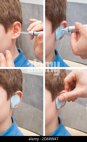 Set per creare un auricolare personalizzato per un bambino. Fasi di produzione dei tappi per le orecchie. doctor realizza tappi auricolari personalizzati per il paziente. Primo piano dell'orecchio Foto Stock