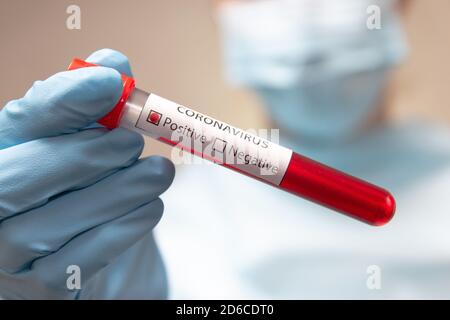 Analisi del sangue coronavirus positivo. Il medico in tuta protettiva, maschera medica e guanti in lattice contiene una provetta con sangue. Foto Stock