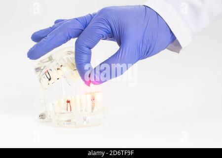 Medico dentista ortopedico raccoglie un dente su un modello di mascella dentale. Concetto di restauro dentale in odontoiatria, protesi di clasp. Foto Stock