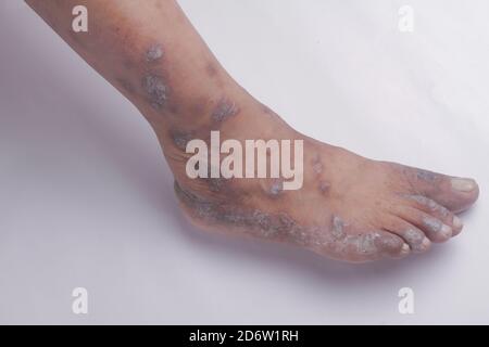 Closeup delle gambe di una donna che soffre di psoriasi cronica su uno sfondo bianco. Closeup di eruzione cutanea e scalatura sulla pelle del paziente. Dermatologico Foto Stock