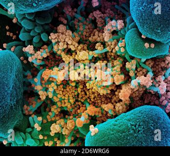 Micrografia elettronica a scansione colorata di una cellula apoptotica (blu) fortemente infettata con particelle di virus SARS-COV-2 (giallo), isolata da un paziente Foto Stock