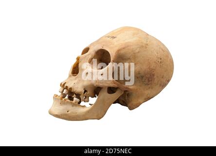 Cranio allungato. Requisito estetico per gli antichi popoli americani. Chille, II secolo AC, Museo delle Americhe, Madrid, Spagna Foto Stock
