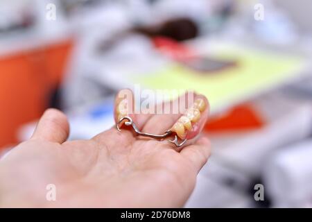 Modello di impianto dentale ponte dentale in mano, studio dentistico sfondo Foto Stock