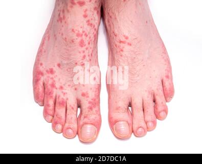 Disturbi della pelle come orticaria. Gambe umane con eruzione cutanea isolata su bianco. Foto Stock