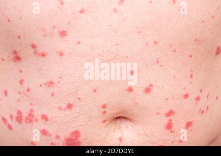 Primo piano di disturbi della pelle come orticaria o allergia. Corpo umano con eruzione cutanea Foto Stock