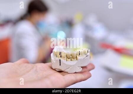 Modello in gesso di denti di mascella con corone in ceramica Foto Stock