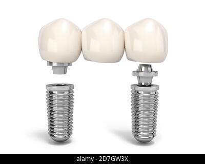 Dente umano impianto multitooth concetto dentale denti umani o protesi dentarie rendering 3d multitooth su bianco Foto Stock