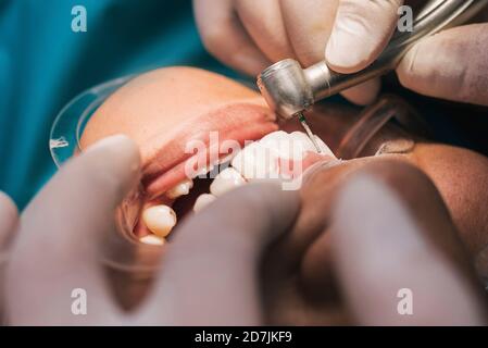 Bocca della paziente durante la procedura ortodontica Foto Stock