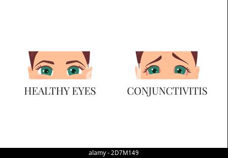 Congiuntivite contro occhi sani, illustrazione concettuale. Donna con e senza congiuntivite in vista ravvicinata. Malattia virale infettiva. Foto Stock