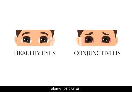 Congiuntivite contro occhi sani, illustrazione concettuale. Uomo con e senza congiuntivite in vista ravvicinata. Malattia virale infettiva. Foto Stock