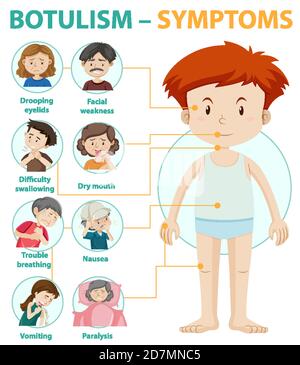 Informazioni sui sintomi del botulismo illustrazione infografica Illustrazione Vettoriale