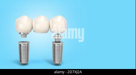 Dente umano impianto multitooth concetto dentale denti umani o protesi dentarie rendering 3d a più denti su gradiente blu Foto Stock