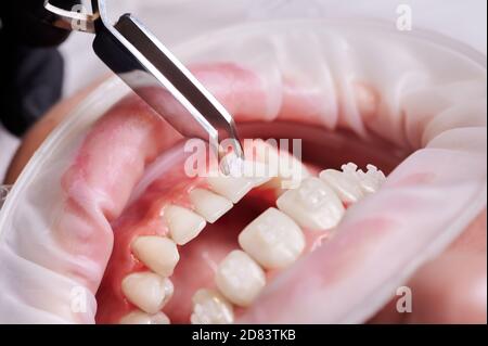 Istantanea ravvicinata di una bocca con divaricatore di guance, pinzette dentali che fissano la staffa al dente inferiore. Fotografia macro. Trattamento ortodontico e concetto di accessori dentali Foto Stock