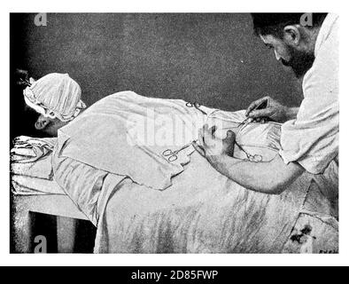 Sanità e medicina vintage illustrazione: Rimozione chirurgica dell'appendice con un'incisione aperta nell'addome (laparotomia) Foto Stock