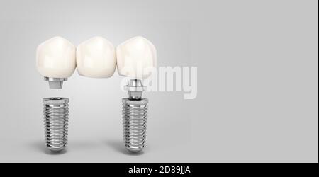 Dente umano impianto multitooth concetto dentale denti umani o protesi dentarie rendering 3d a più denti su gradiente grigio Foto Stock