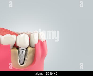 Dente umano singolo impianto concetto dentale denti umani o dentellature rendering 3d su gradiente grigio Foto Stock