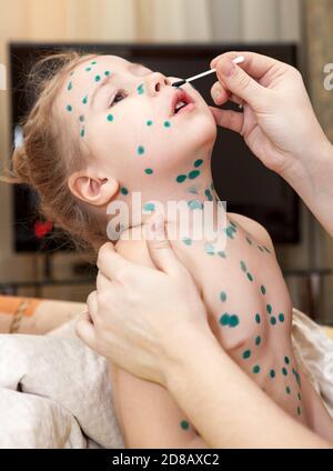La madre tratta il rash del bambino nella stanza domestica. Virus della varicella o eruzione cutanea da bolle di varicella sul bambino Foto Stock