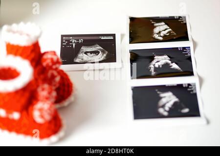 Booties e un'immagine ecografica su sfondo bianco, primo piano. Concetto di pianificazione familiare e gravidanza. Foto Stock