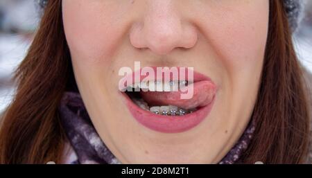 sistema a brasket in bocca sorridente, macro denti foto, primo piano labbra,