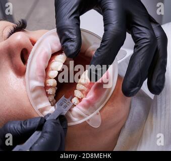 Primo piano del medico in guanti neri utilizzando un calibro a staffa in alluminio durante il fissaggio dei rinforzi ai denti del paziente. Donna con divaricatore di guancia e staffe ortodontiche sui denti che hanno la procedura dentale in clinica. Foto Stock