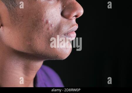 primo piano del viso del giovane uomo con problema di pelle . Foto Stock