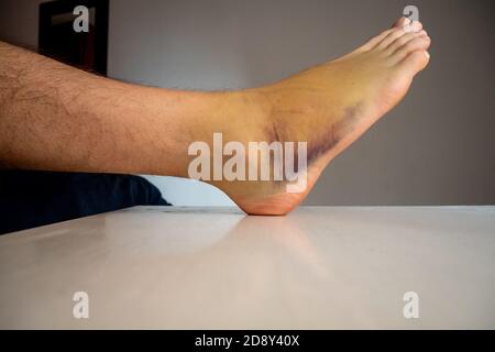 Livido piede destro, noto anche come contusione su una grande area con Foto Stock