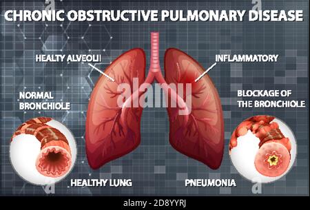 Illustrazione della malattia polmonare ostruttiva cronica Illustrazione Vettoriale