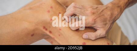Gambe con molti macchia rossa e cicatrice da punture di insetto. Allergia alle zanzare. BANDIERA dei morsi di mosca di sabbia, FORMATO LUNGO Foto Stock
