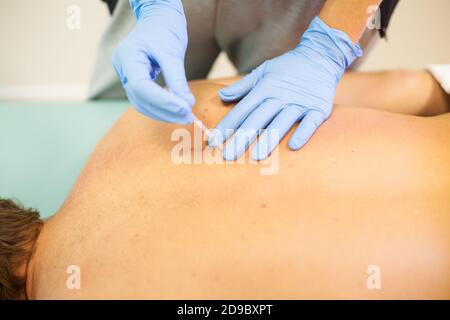 Il medico infila l'ago nel corpo dell'uomo sull'agopuntura Foto Stock