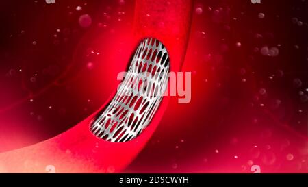 L'intervento chirurgico di bypass dell'arteria coronaria è una procedura chirurgica per ripristinare il normale flusso sanguigno in un'arteria coronaria ostruita. Angioplastica. Colesterolo Foto Stock